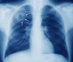 En pandemia suben muertes por tuberculosis