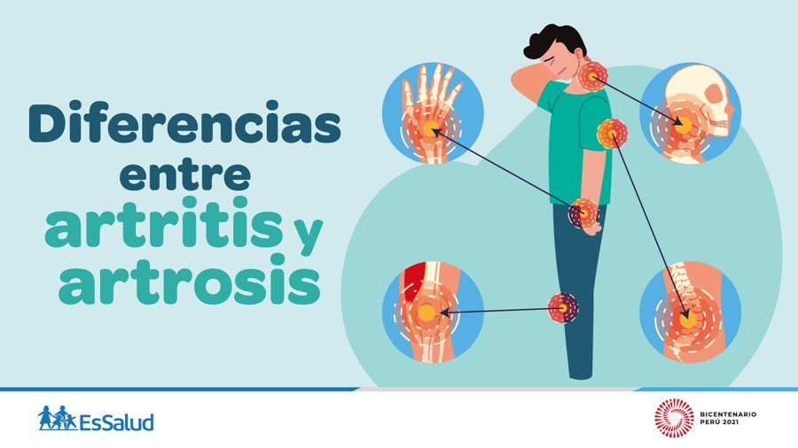Conoce las principales causas de la artritis y la artrosis - De Luna  Noticias