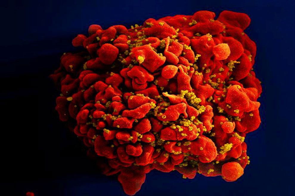 A ocho lustros del primer caso no hay vacuna exitosa contra VIH-sida